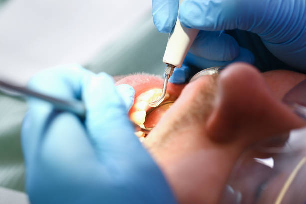 Best Emergency Dental Care for Broken or Chipped Teeth in Larkfield Wikiup, CA